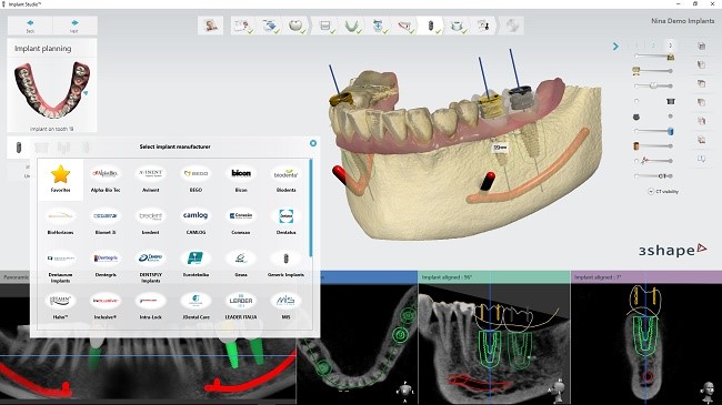 3Shape releases Implant Studio® 2016