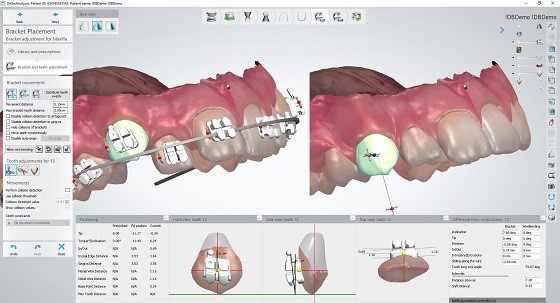 3Shape Orthodontic software with IDB bracket workflow