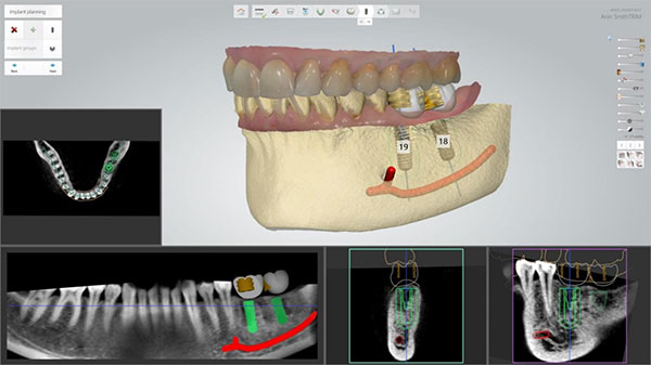 Implant Studio software dentistry
