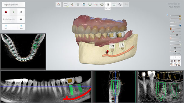 Straumann Dental Implant System library