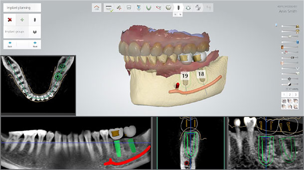 evaluating bone density and nerve positions in dentistry